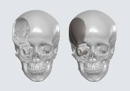 reconstituição por tomografia e arquivo STL usinagem CNC de placa craniana